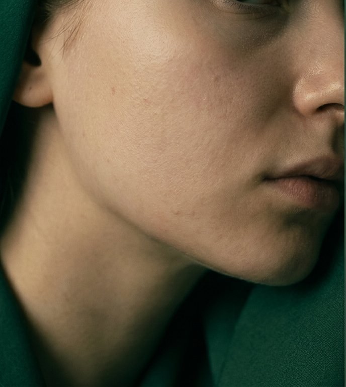 Before skin rejuvenation, duller, uneven complexion