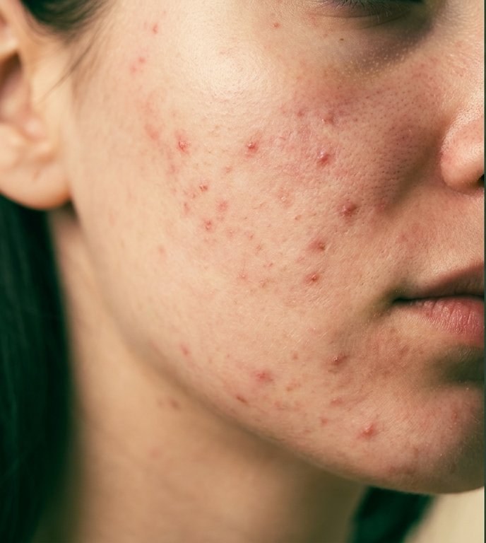 Before acne care, active breakouts